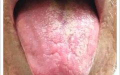 Traditional Chinese Medicine Tongue Diagnosis: Illustrated Guide to 14 Types of Tongue Shapes and Qualities