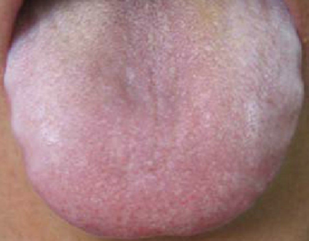 What Does the Tongue of a Phlegm-Damp Constitution Look Like in Traditional Chinese Medicine?