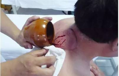 The Benefits of Bloodletting Therapy in Traditional Chinese Medicine