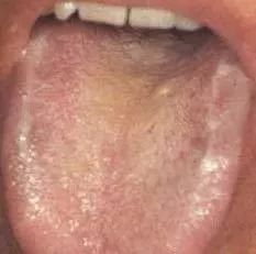 Understanding Tongue Diagnosis in Traditional Chinese Medicine (with Tongue Diagnosis Illustrations)