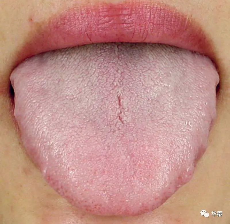 What is Qi Deficiency and What Symptoms Does It Present?