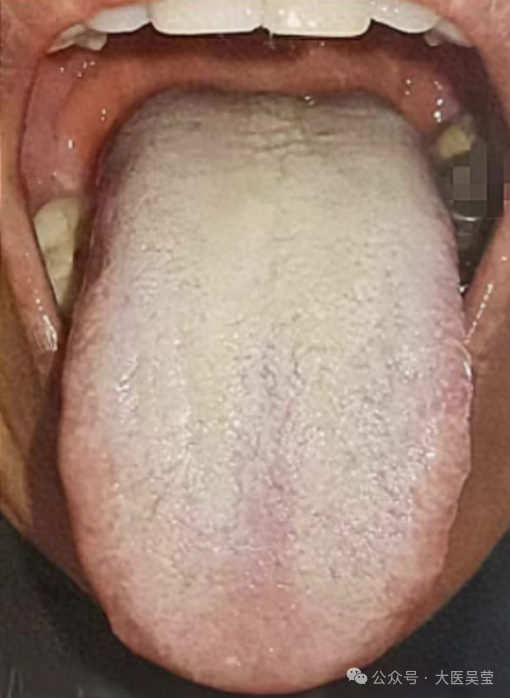 Thick, Greasy, White Coating on the Tongue: Why Shenling Baizhu San and Erchen Wan Are Ineffective!