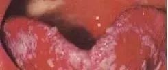 Understanding Tongue Diagnosis in Traditional Chinese Medicine (with Tongue Diagnosis Illustrations)
