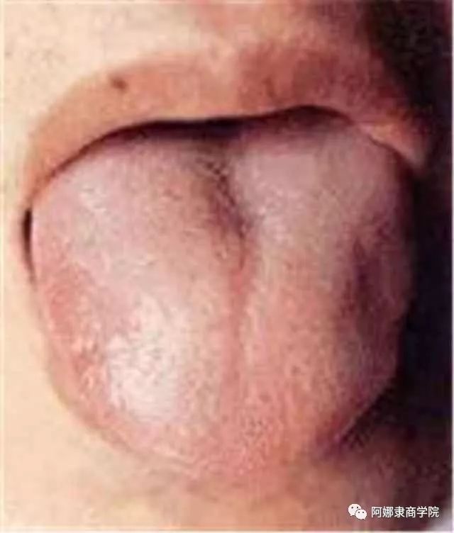 A Comprehensive Guide to 22 High-Definition Tongue Diagnosis Images: Understand Diseases Through Tongue Observation!