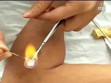 The Powerful Energy of Fire Needles