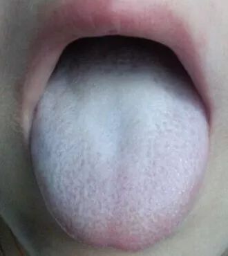 Is a Thick Tongue Coating Always a Sign of Food Accumulation? Can Food Accumulation Be Indiscernible?