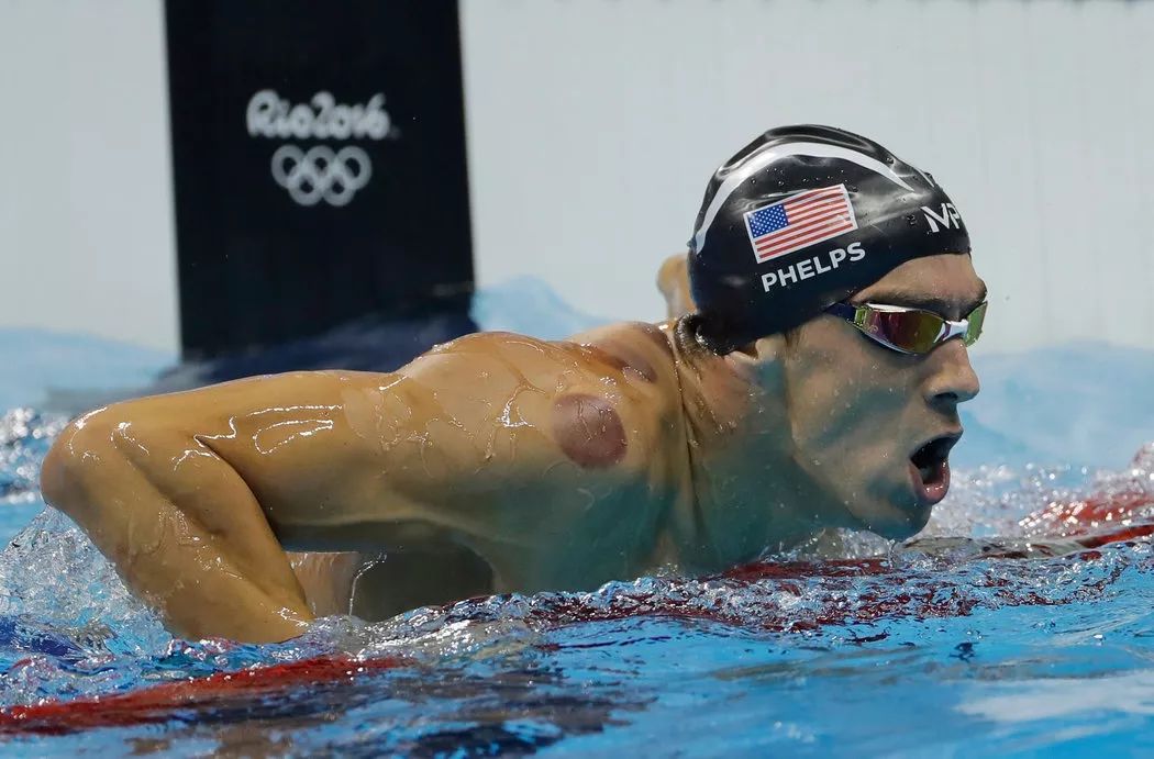 How to Use Cupping Therapy Without Pain?