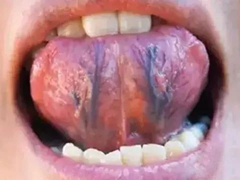 When Your Tongue Shows This Signal: Don't Delay!