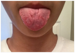 Observing Tongue Coating to Assess Health: A Summary of Classic Tongue Signs in Traditional Chinese Medicine