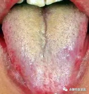 Understanding Your Tongue Diagnosis in 10 Minutes