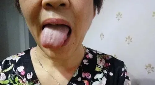 When Your Tongue Shows This Signal: Go to the Hospital Immediately, Don't Delay!