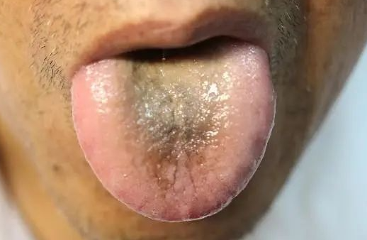 Four Tongue Coating Colors Revealing Your Body Condition