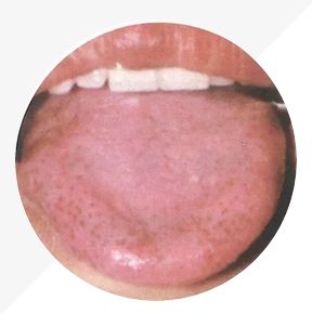 Understanding Tongue Diagnosis in TCM: Insights into Health from Tongue Appearance (Part 2)