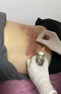 Understanding Fire Needle Therapy in Traditional Chinese Medicine