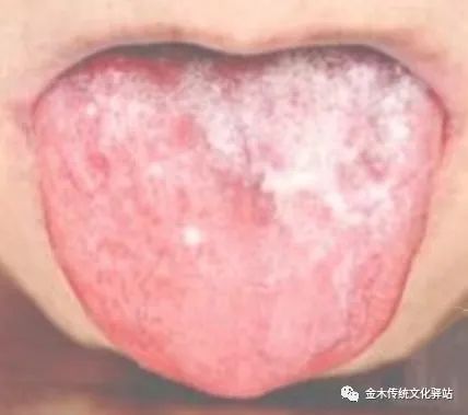 Tongue Diagnosis in Traditional Chinese Medicine: Characteristics of Tongue Coating