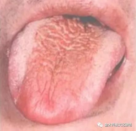 Tongue Diagnosis in Traditional Chinese Medicine: Tongue Coating
