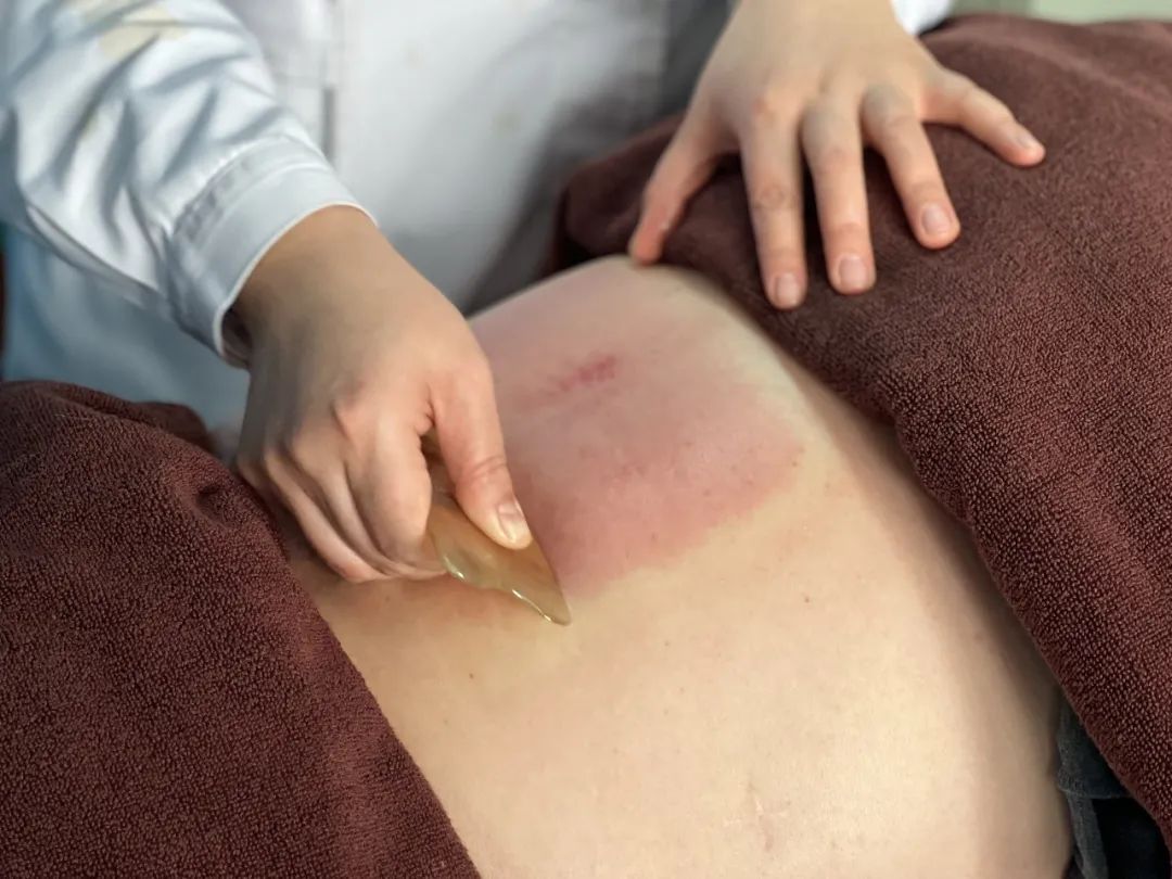 Traditional Chinese Medicine Therapy | 'Gua Sha' for Better Health!