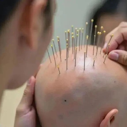 Unveiling Acupuncture Treatment: Is Five Sessions Considered a Course?