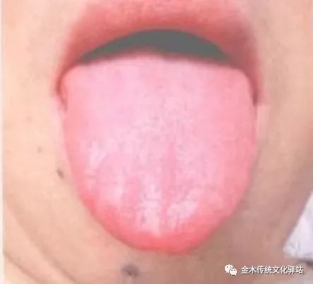 Tongue Diagnosis in Traditional Chinese Medicine: Tongue Coating