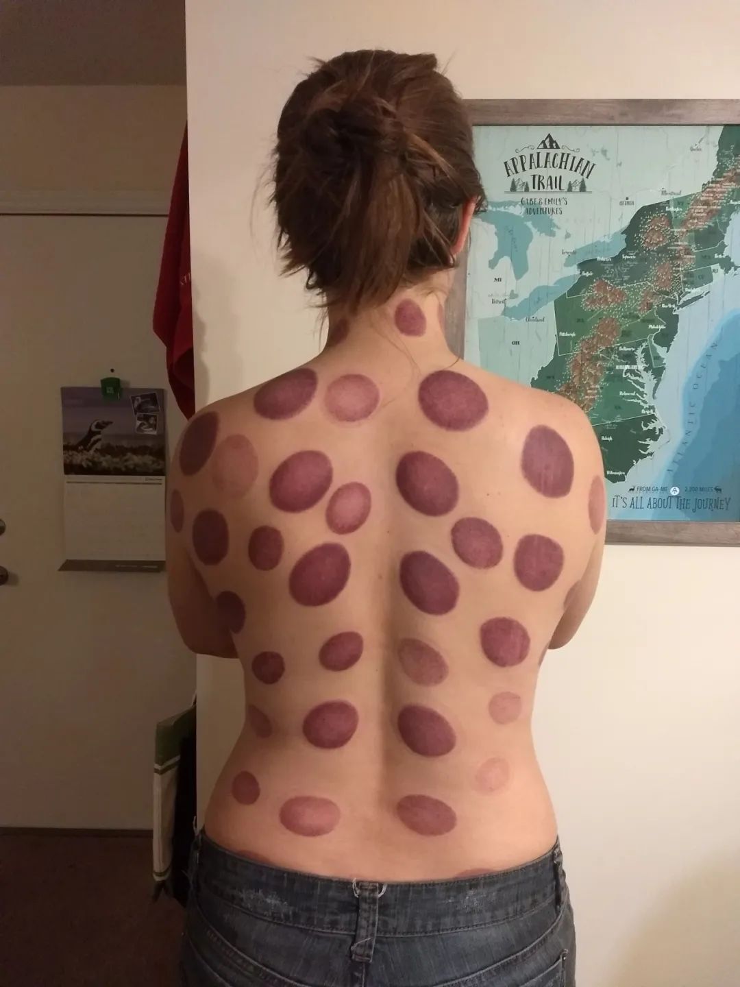 Everything You Need to Know About Cupping Therapy