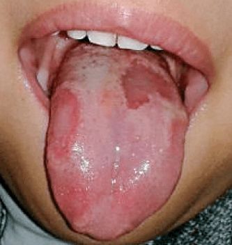 What Does the Tongue of a Person with Yin Deficiency Look Like?
