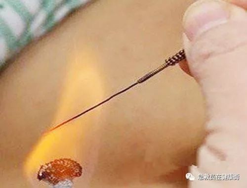Fire Needle Therapy in Traditional Chinese Medicine