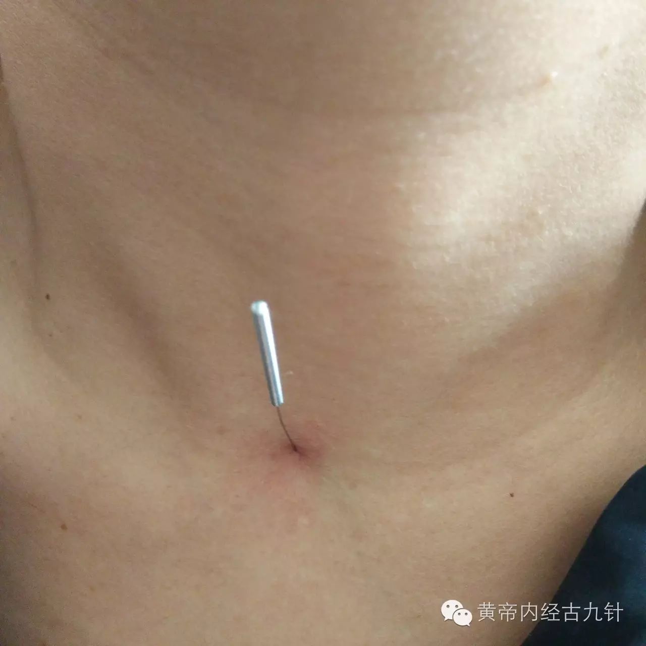 Discussion on the 'Mao Zhen' (Fine Needle) Technique