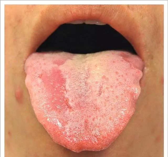 Traditional Chinese Medicine Tongue Diagnosis: 26 Clinical High-Definition Tongue Diagnosis Images with Analysis
