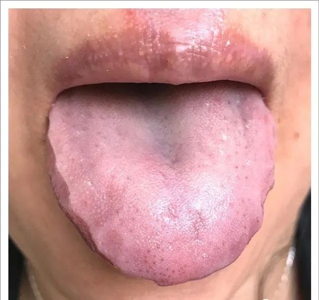 Traditional Chinese Medicine Tongue Diagnosis: 26 Clinical High-Definition Tongue Diagnosis Images with Analysis
