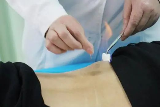 Acupuncture Department II: What Conditions Can Fire Needle Therapy Treat?