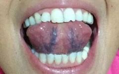Understanding Blood Stasis: Key Points to Consider for Effective Treatment