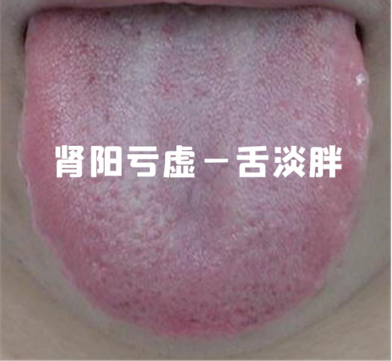 Distinguishing and Treating Kidney Yang Deficiency, Kidney Yin Deficiency, and Kidney Essence Deficiency