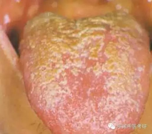Traditional Chinese Medicine Tongue Diagnosis - Tongue Coating