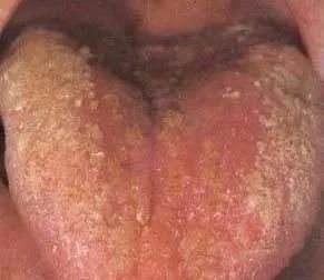 Understanding Tongue Diagnosis in Traditional Chinese Medicine (with Tongue Diagnosis Illustrations)