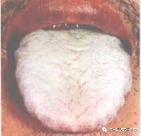 Tongue Diagnosis in Traditional Chinese Medicine: Tongue Coating