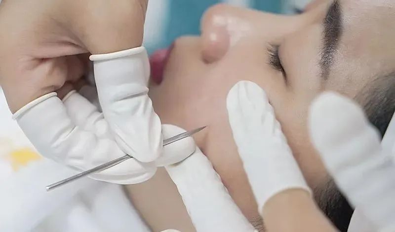Understanding Needle Cleansing and Fire Needle Therapy in Acne Treatment