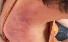 The Many Benefits of Gua Sha in Traditional Chinese Medicine