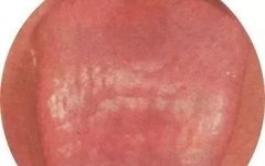 What Can Tongue Quality and Coating Reveal? The Significance of Tongue Diagnosis