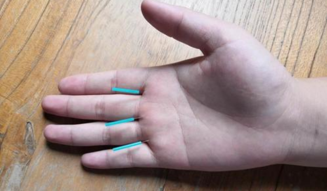 The Miraculous "Three Needles" in TCM Acupuncture: Treating One Disease with Three Acupuncture Points