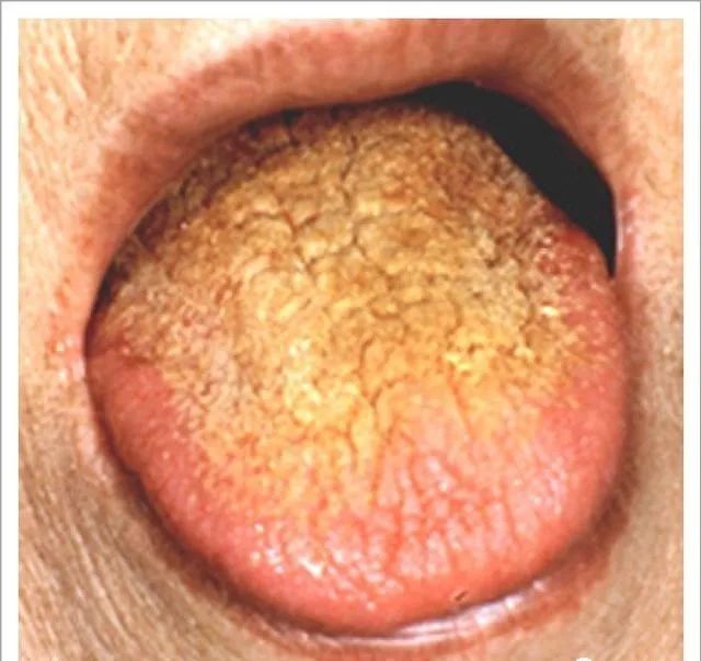 Traditional Chinese Medicine Tongue Diagnosis: 26 Clinical High-Definition Tongue Diagnosis Images with Analysis