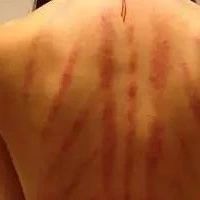 Is the Sha and Bruise from Gua Sha the Same? Is Gua Sha Difficult to Learn?