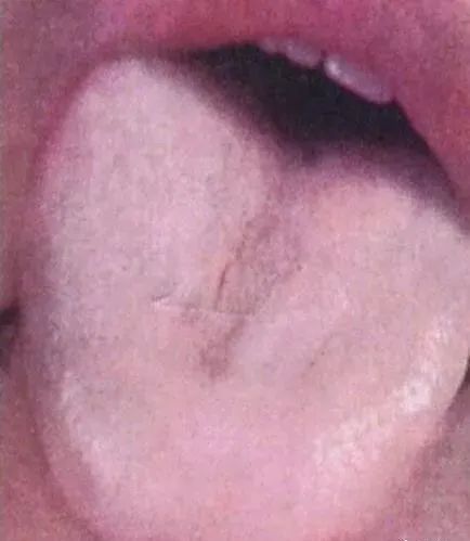 Comprehensive Guide to Tongue Diagnosis and Associated Conditions in TCM