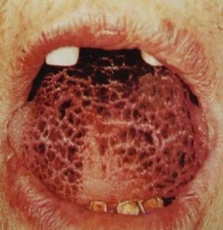 Comprehensive Guide to Tongue Diagnosis and Associated Conditions in TCM