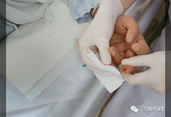 The Wonders of Bloodletting Therapy in Traditional Chinese Medicine