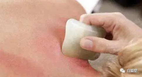 The Origins, Techniques, and Precautions of Gua Sha (Gua Sha: A Localized Method to Improve Circulation, Delay Aging, Promote Qi and Blood Flow, and Alleviate Pain)