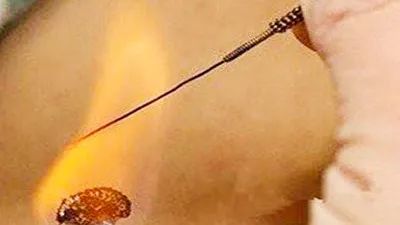 Understanding Fire Needle Therapy