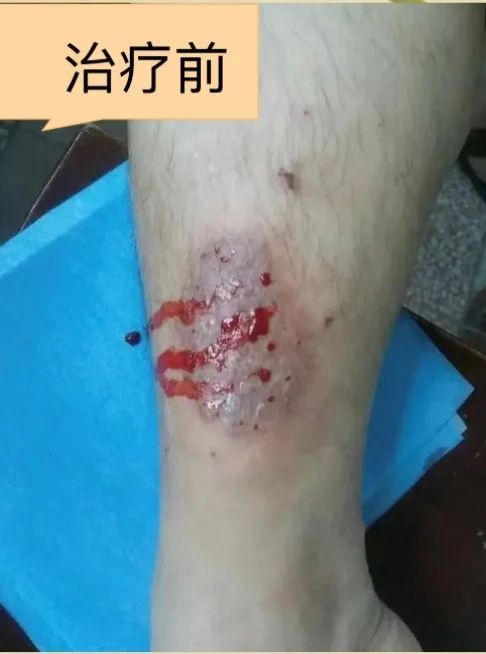 Dermatology: TCM Fire Needle Technique for Treating Skin Diseases