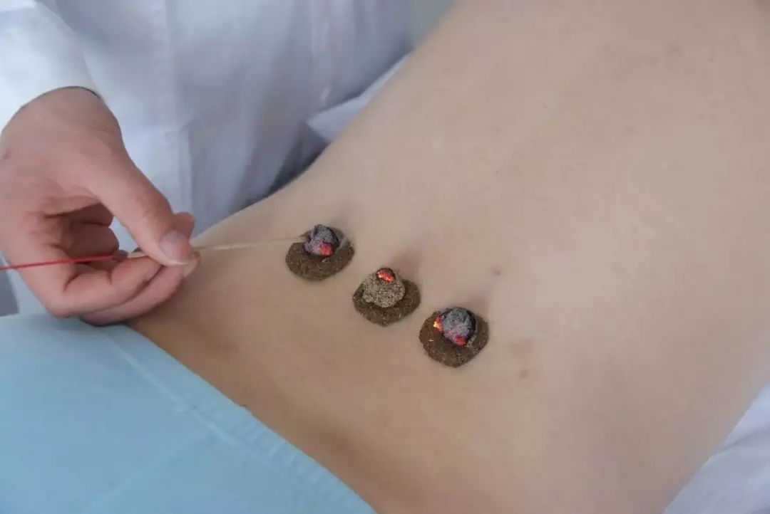 What Are the Classifications of Moxibustion?