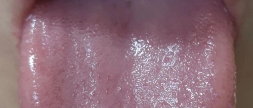 Tongue Diagnosis in Taiyang Disease According to the Treatise on Cold Damage