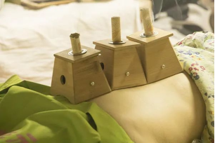 Specialized Therapies | Various Unique Moxibustion Techniques in TCM for Health and Disease Prevention